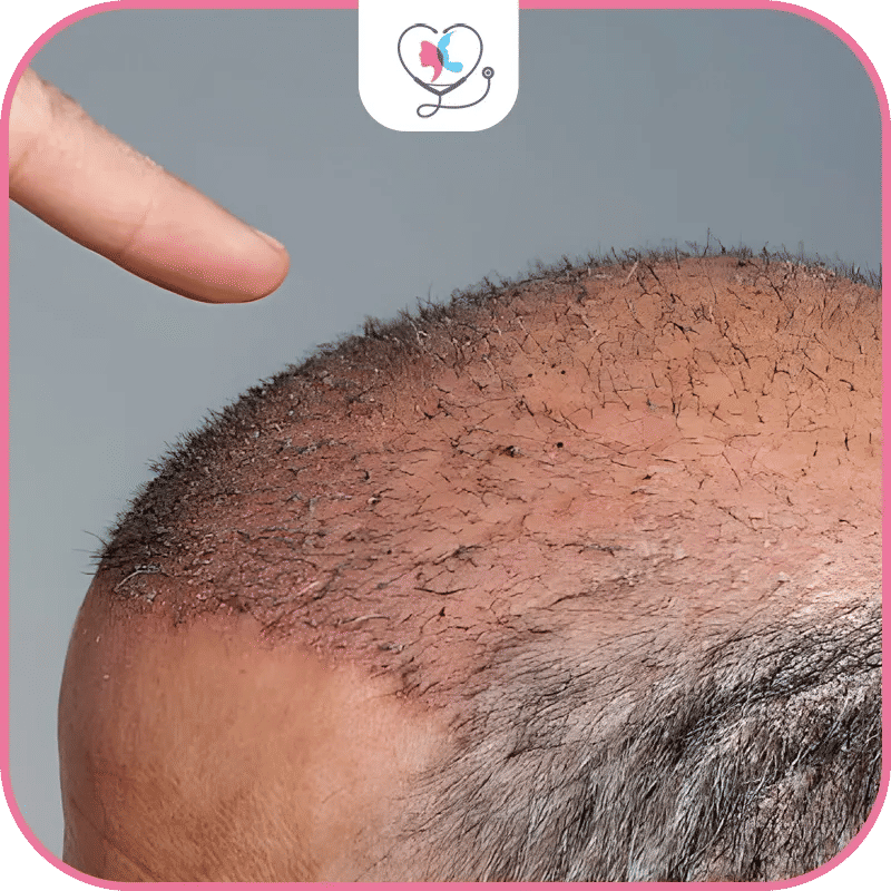 Post Hair Transplant Care
