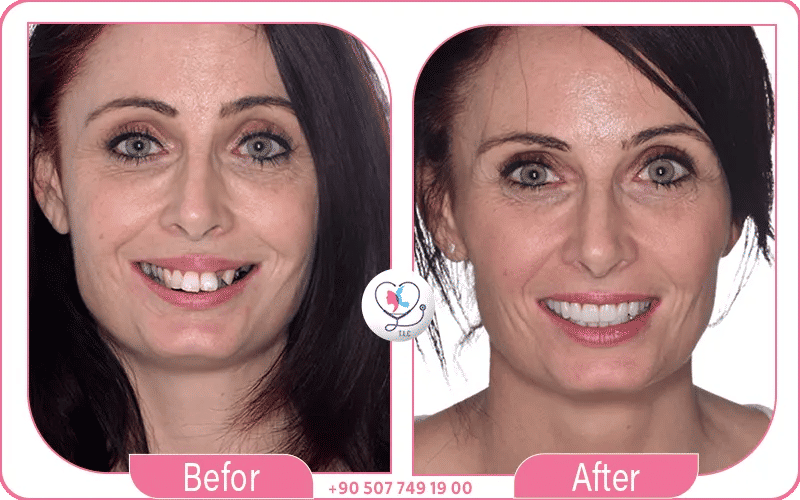 Avis et témoignages sur la resultat implant dentaire avant après