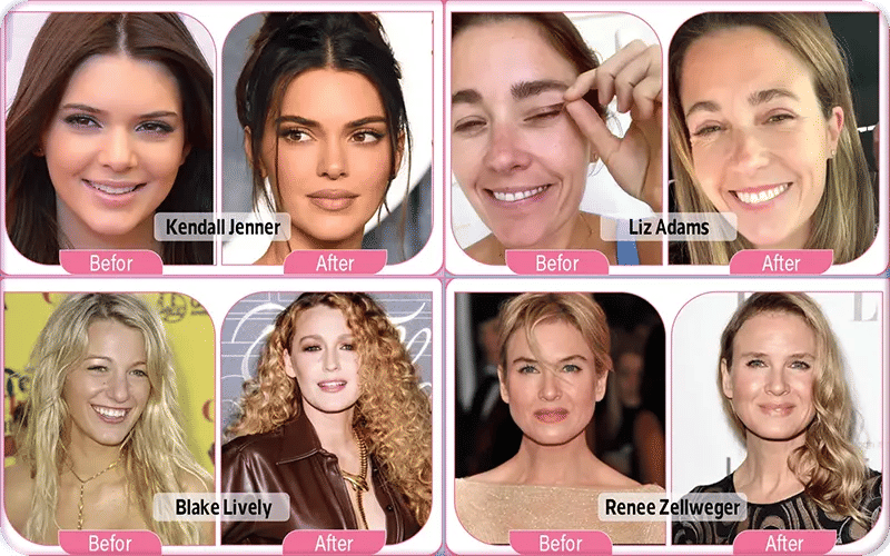 Celebrity Upper Blepharoplasty Before and After