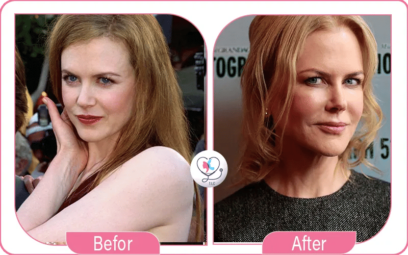 Suspected Nicole Kidman Cosmetic Surgery 2