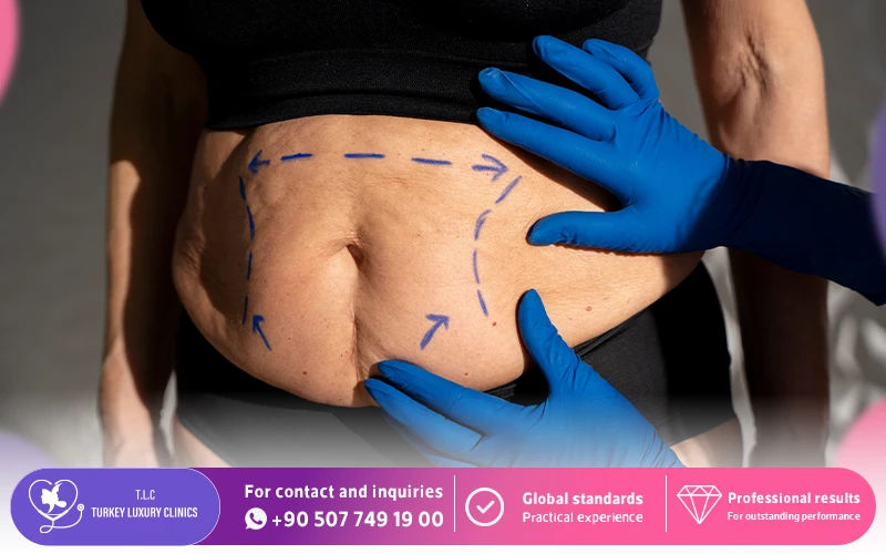 Who Is a Good Candidate for Laser Liposuction (SmartLipo)?