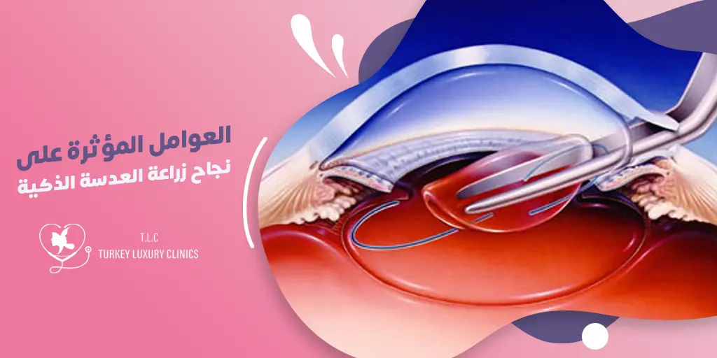 عوامل نجاح زراعة العدسة الذكية