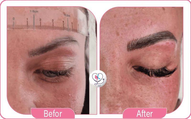 Eyebrow Transplant Before and After Recovery Aftercare