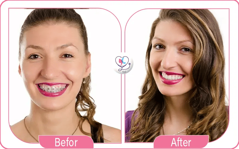 تجربتي مع تقويم الأسنان المعدني