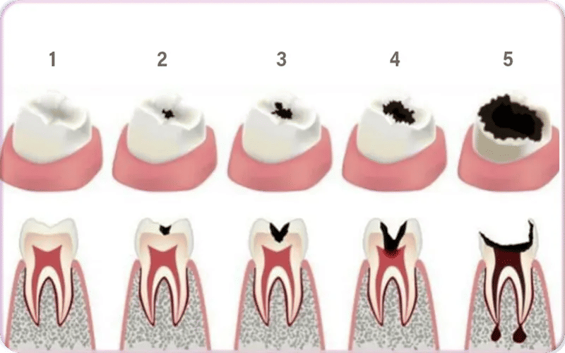 Les 5 stades de la carie : Une course contre la montre