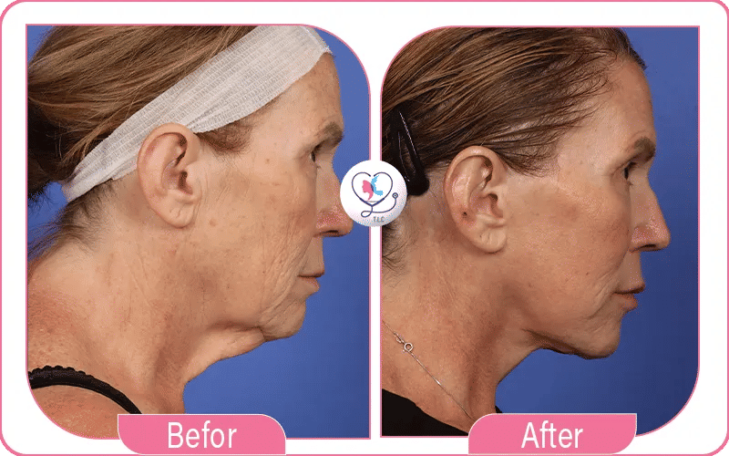 What to Expect During Mini Neck Lift Recovery?