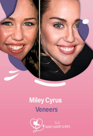 Carillas Dentales de Miley Cyrus: Cambios 2025 y Transformaciónfeatured image
