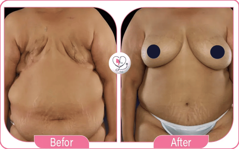 reconstruction mammaire après cancer photo-2