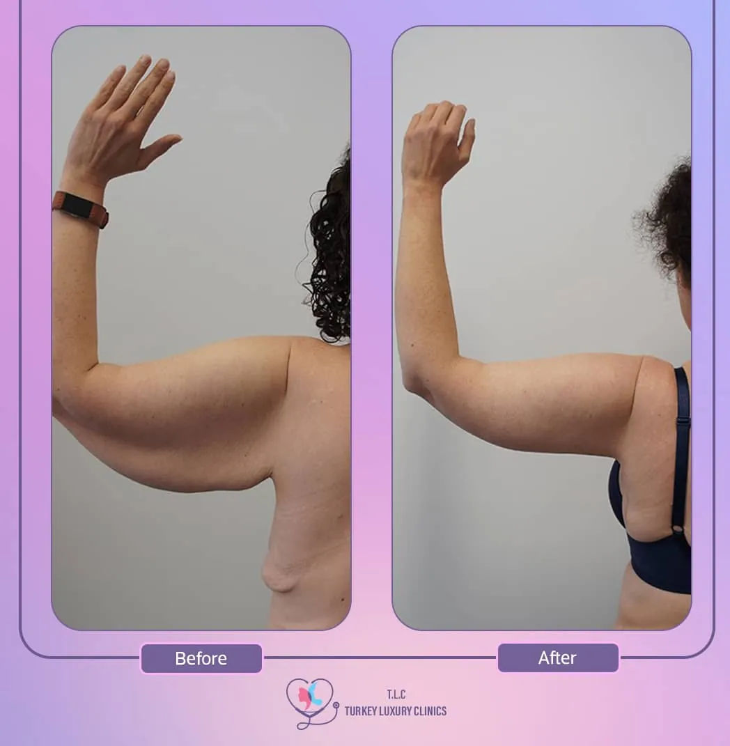 كيف كانت تجربتي مع ترهلات الذراعين قبل العملية؟