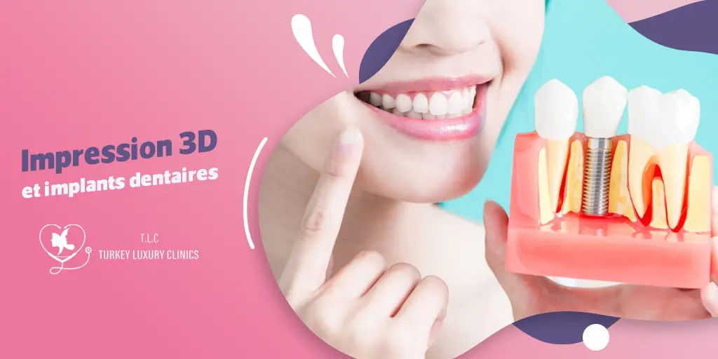 Impression 3D et implants dentaires