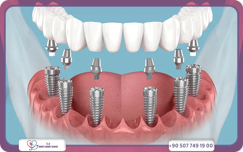 Pourquoi les prix des implants All-on-6 varient autant selon le pays ?