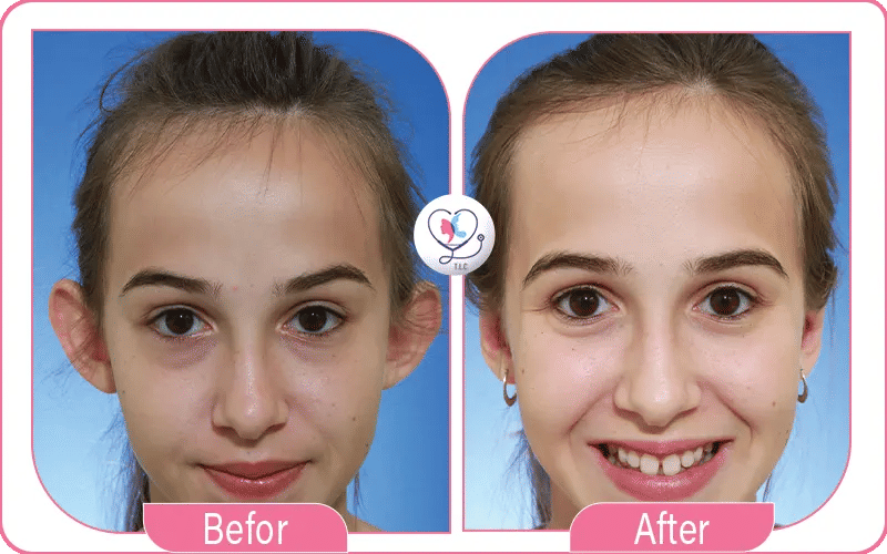 Otoplasty Recovery Pictures