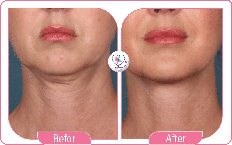 Nefertiti Neck Lift Before & After Photos: What to Expect image 1772044334302