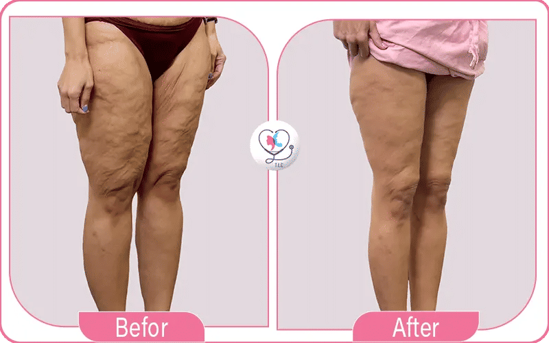 تجربتي مع عملية شد الأفخاذ 2