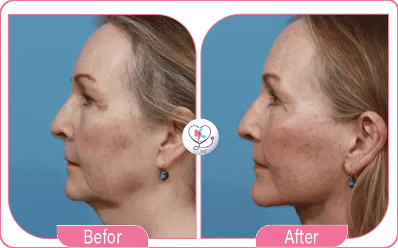 تكساس للوجه قبل وبعد