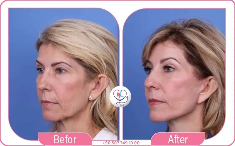 مزايا إجراء عملية شد الوجه مع تركيا لاكشري كلينك