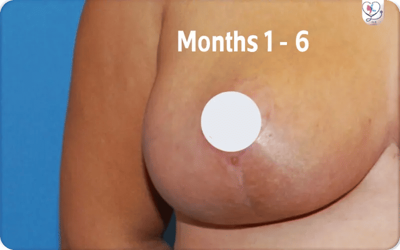 Mid Stages (Months 1   6)