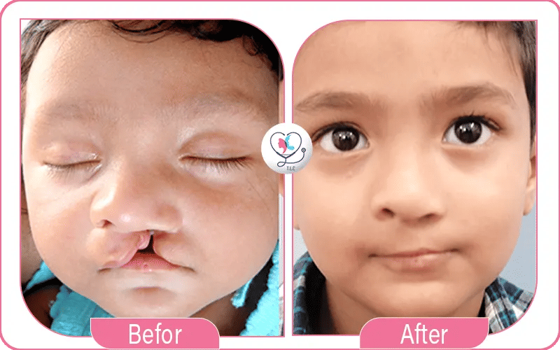 Dans quels cas a-t-on recours à la chirurgie reconstructrice ?