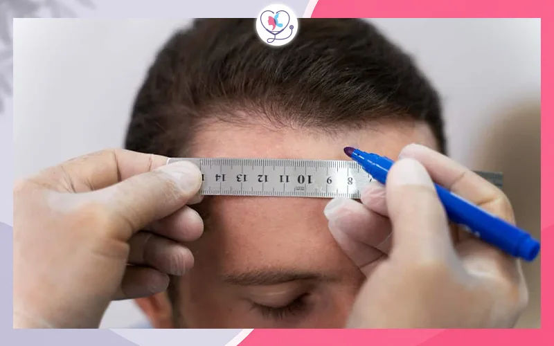 عدم تناسق خط الشعر