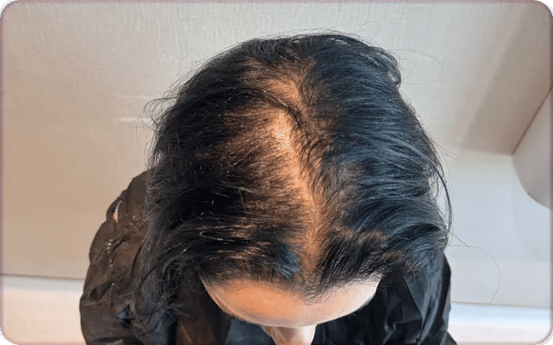 Échelle de Ludwig : Comment mesurer la perte de cheveux chez la femme ?