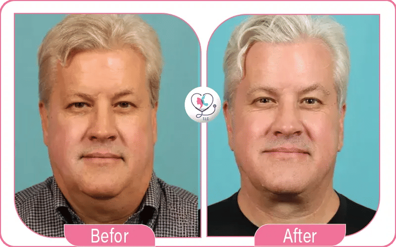 Why Choose Turkey for Male Neck Lift?