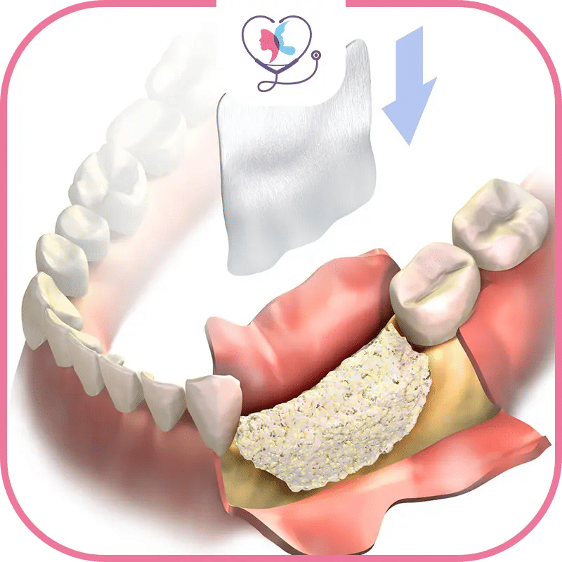 qu’est-ce-qu'une-greffe-osseuse-dentaire-?