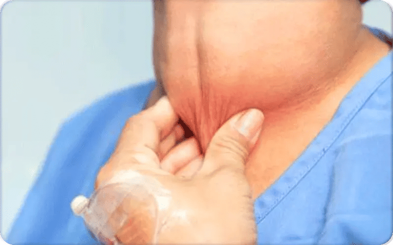 علاج تضخم الغدة الدرقية