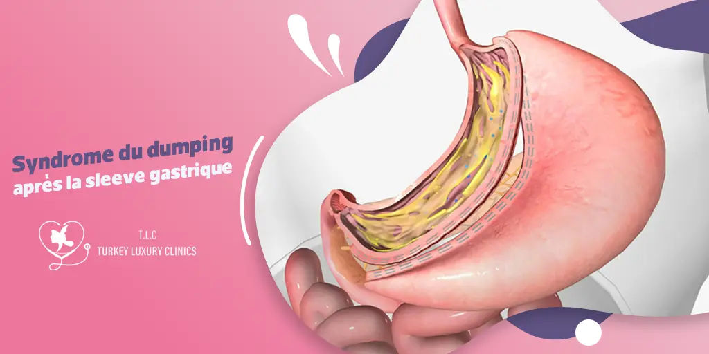 Syndrome du dumping après la sleeve gastrique