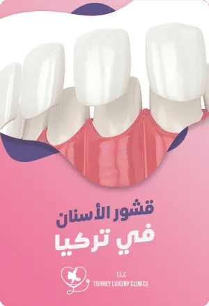 قشور الأسنان في تركيا