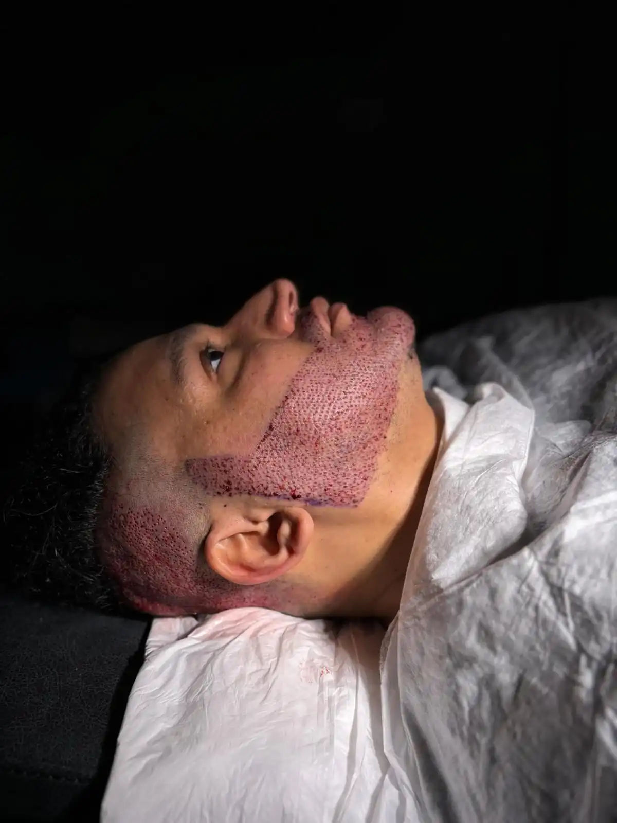 ما قبل زراعة شعر اللحية