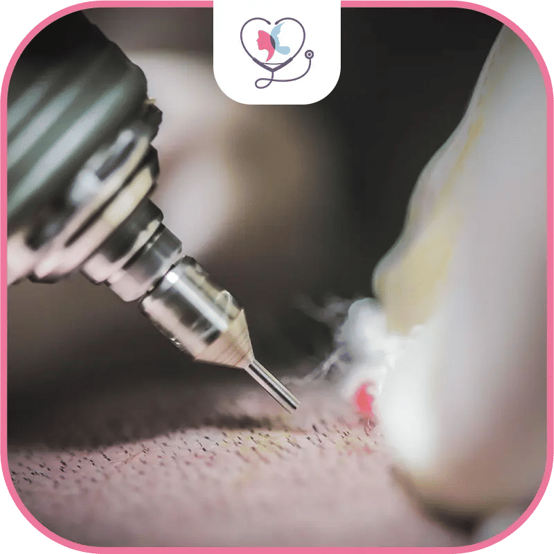 What is Perkutan Hair Transplant Procedure?