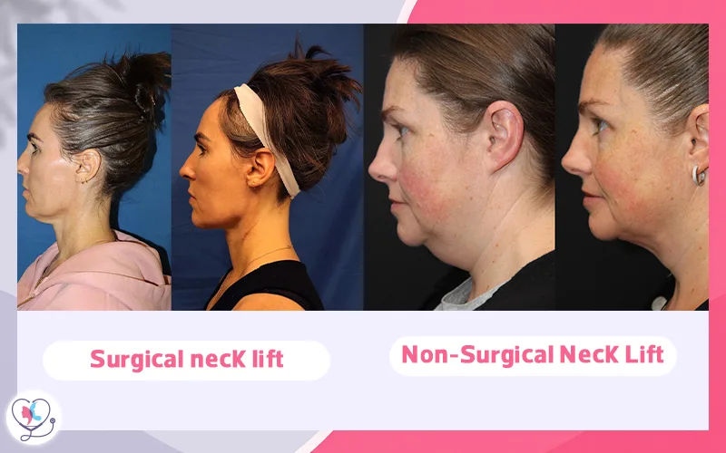 Surgical Vs Non-Surgical Neck Lift