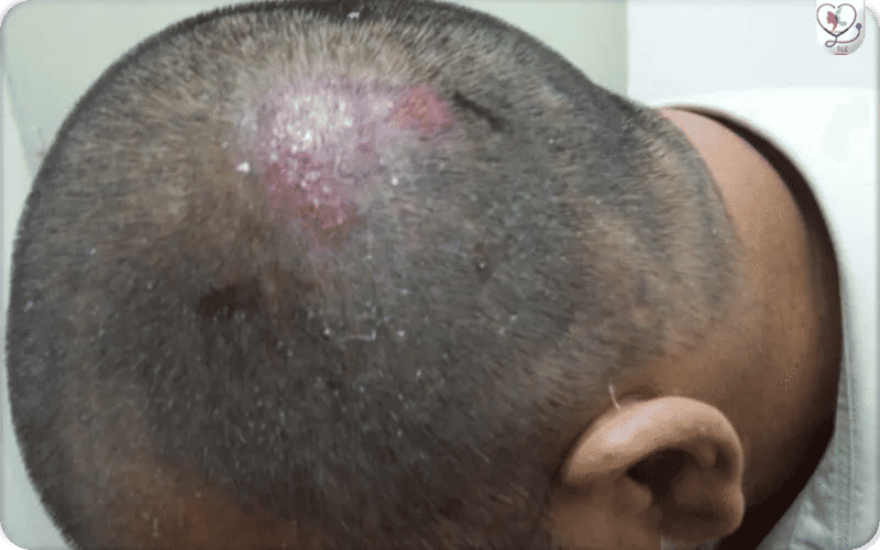 ثانياً: المخاطر والمضاعفات الأقل شيوعاً