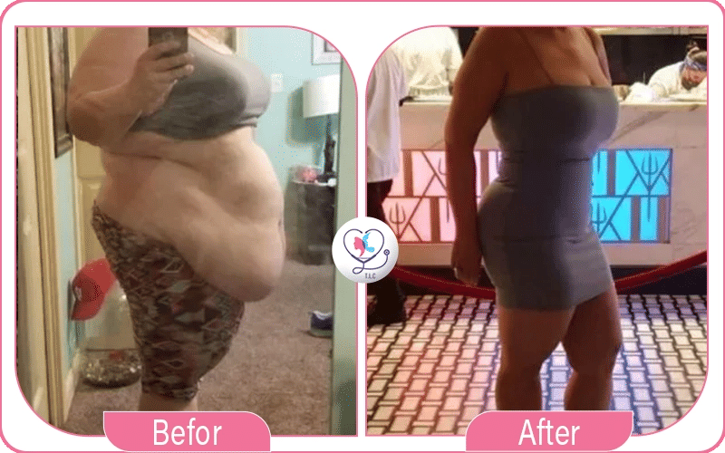 فوائد عملية شد البطن بعد التكميم