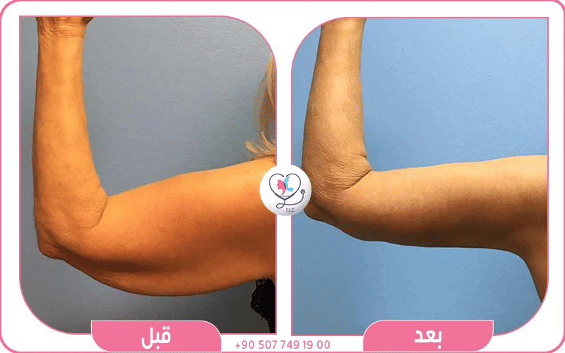 خطوات عملية شد الزنود