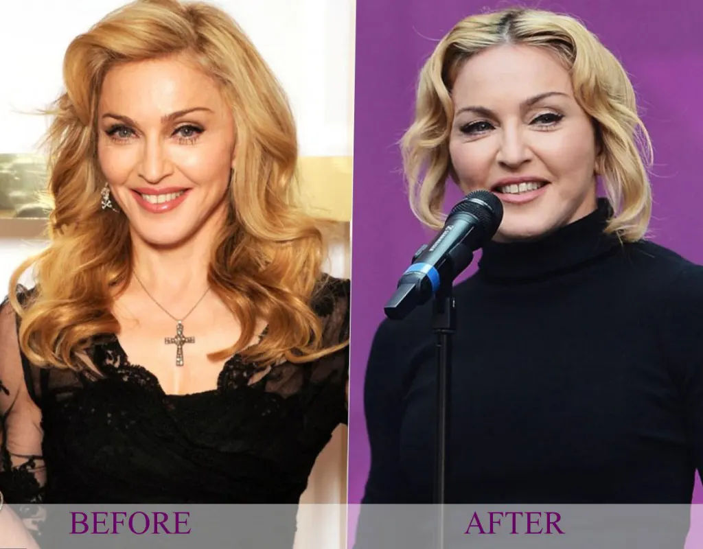 Image comparing Madonna before and after reported cosmetic enhancements.