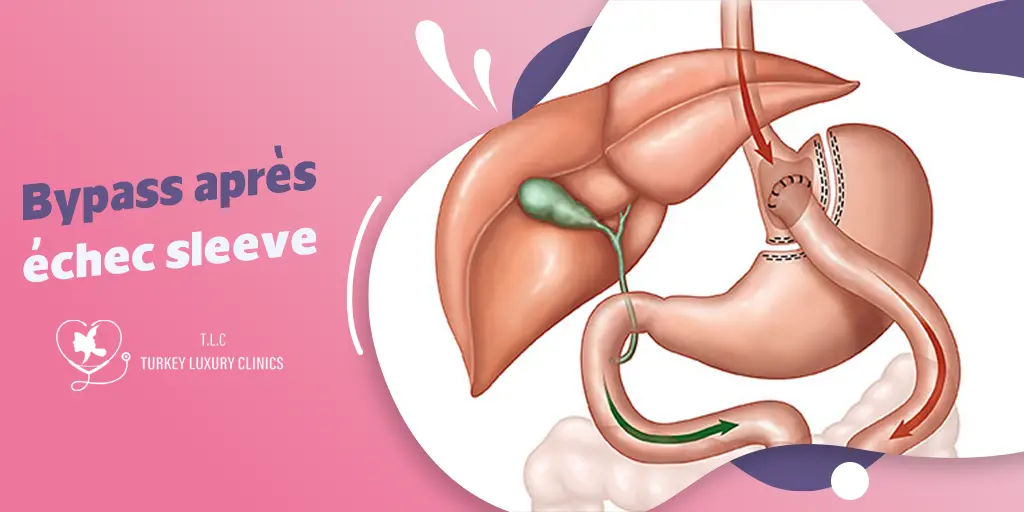 Bypass après échec sleeve : Solution de reprise efficace