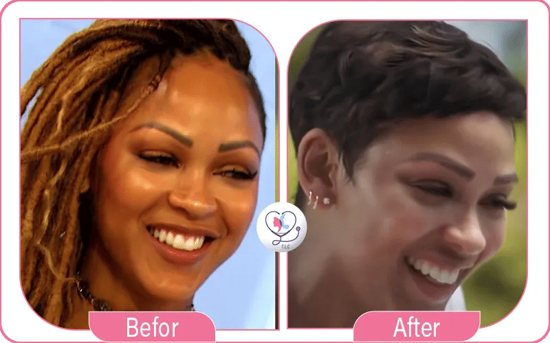 Before and After Eyebrow Transplant Celebrity 2
