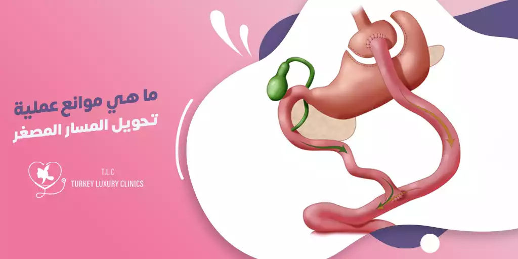 ما هي موانع عملية تحويل المسار المصغر؟