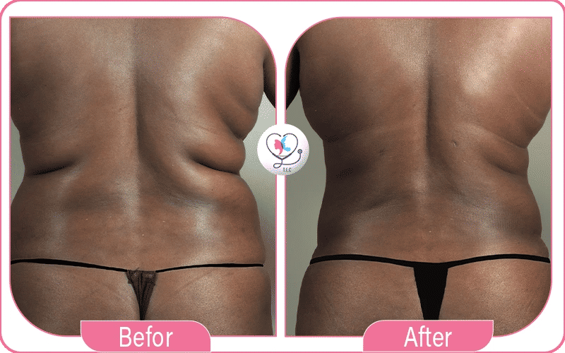 2. Love Handles (Flanks): After Lipo 360 12 Areas