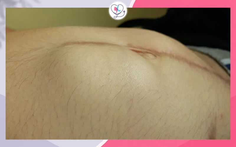 الفتق (Hernia)