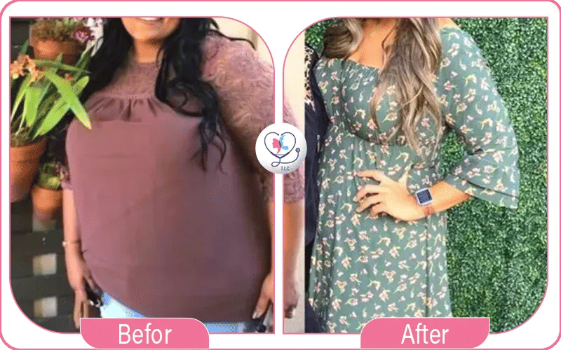 النظام الغذائي بعد تجربتي مع بوتكس المعدة