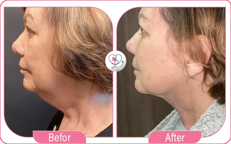 Nefertiti Neck Lift Before & After Photos: What to Expect image 1772044334305