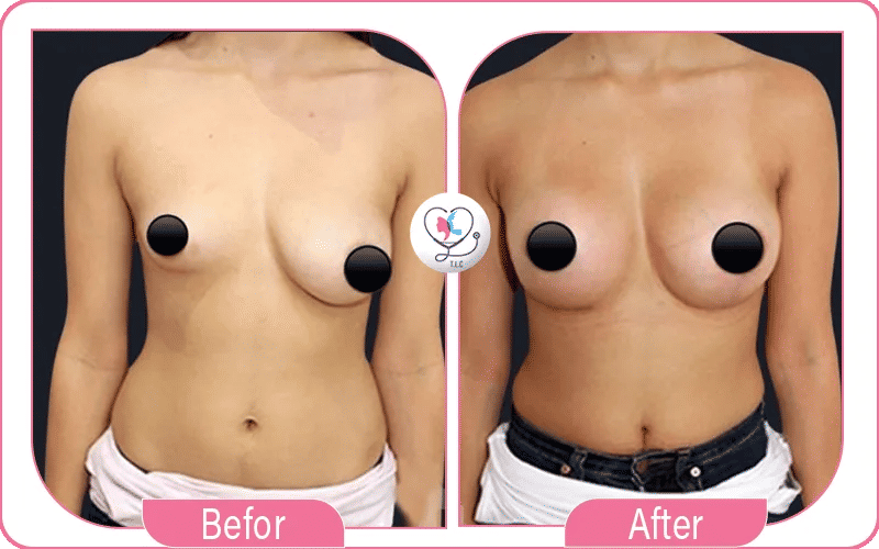 مميزات تجربتي مع سيليكون الثدي