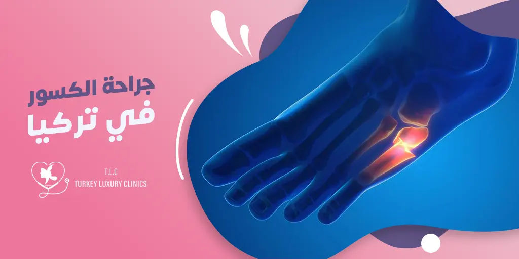 جراحة الكسور الرياضية في تركيا
