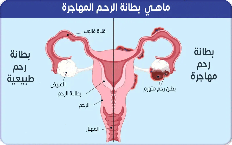 ما هي بطانة الرحم المهاجرة؟