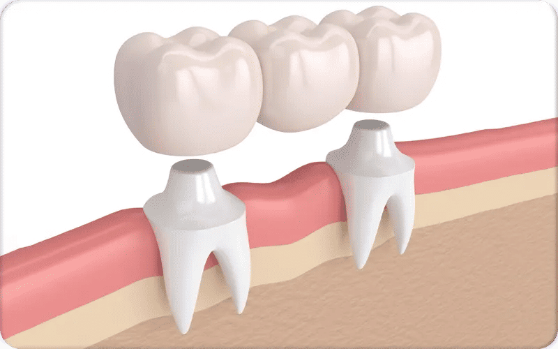 Qu’est-ce qu’un bridge dentaire ?