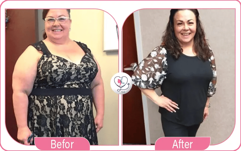 تساقط الشعر بعد التكميم: الأسباب والوقاية والعلاج-1772048967281