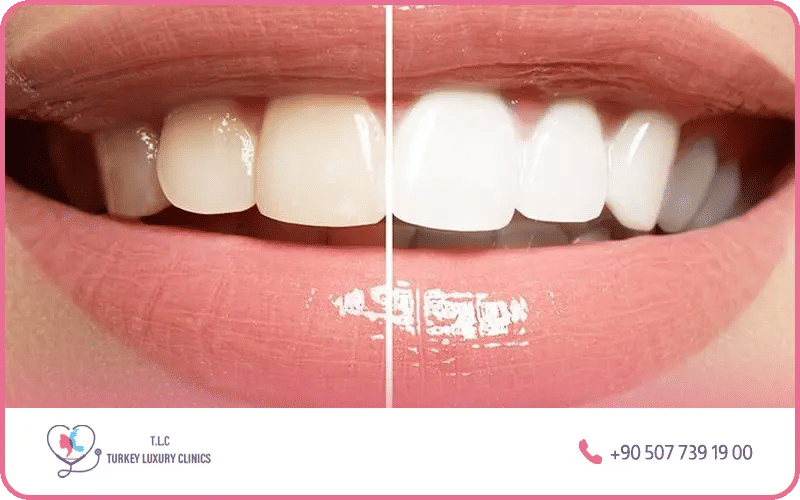 Teeth whitening results Turkey – before and after smile transformation at Turkey Luxury Clinics Istanbul