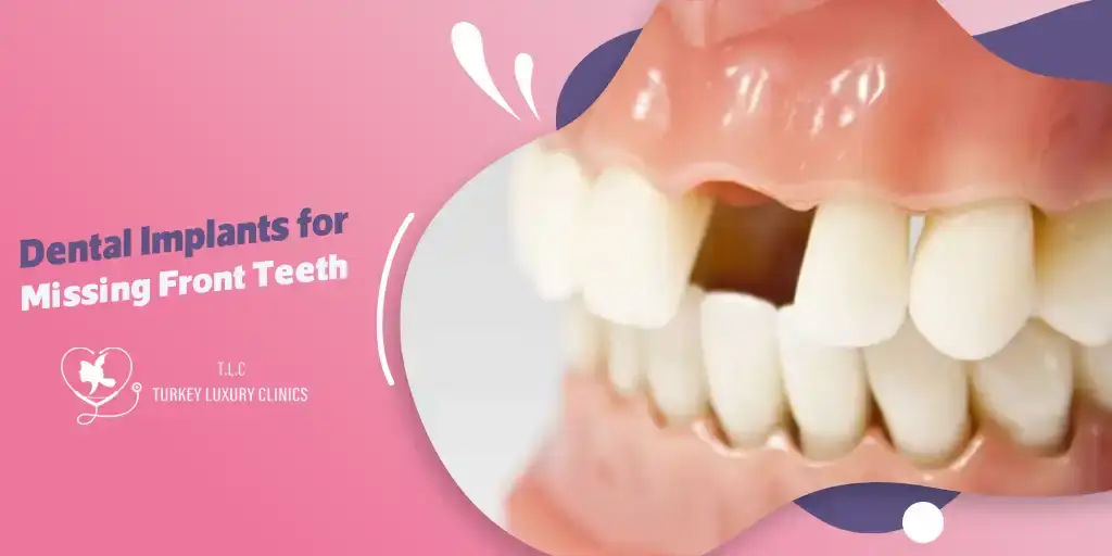 Restore Your Smile: Dental Implants for Missing Front Teeth